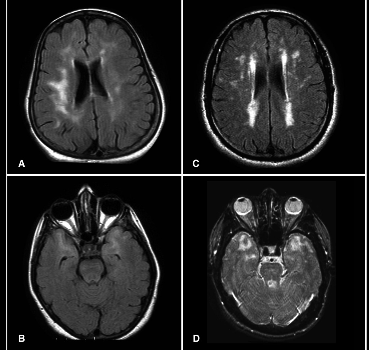Four-panel brain MRI from patients with CADASIL. Panels a, b, and c are axial FLAIR sequences; panel d is axial T2-weighted. All four panels show confluent white matter hyperintensities in the periventricular and deep white matter, with temporal lobe involvement visible in panels a and b. Panel d additionally shows lacunar infarcts in the thalamus, pons, and basal ganglia.
